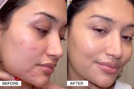 The Ups and Downs of Accutane: What to Expect on Your Journey